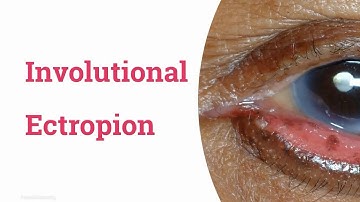 Involutional Ectropion