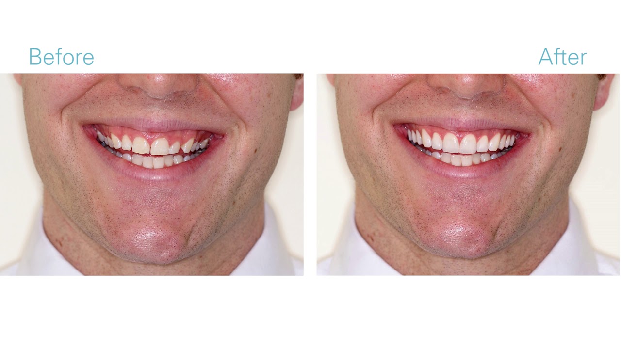 Smile Makeover by 209 NYC Dental specialists