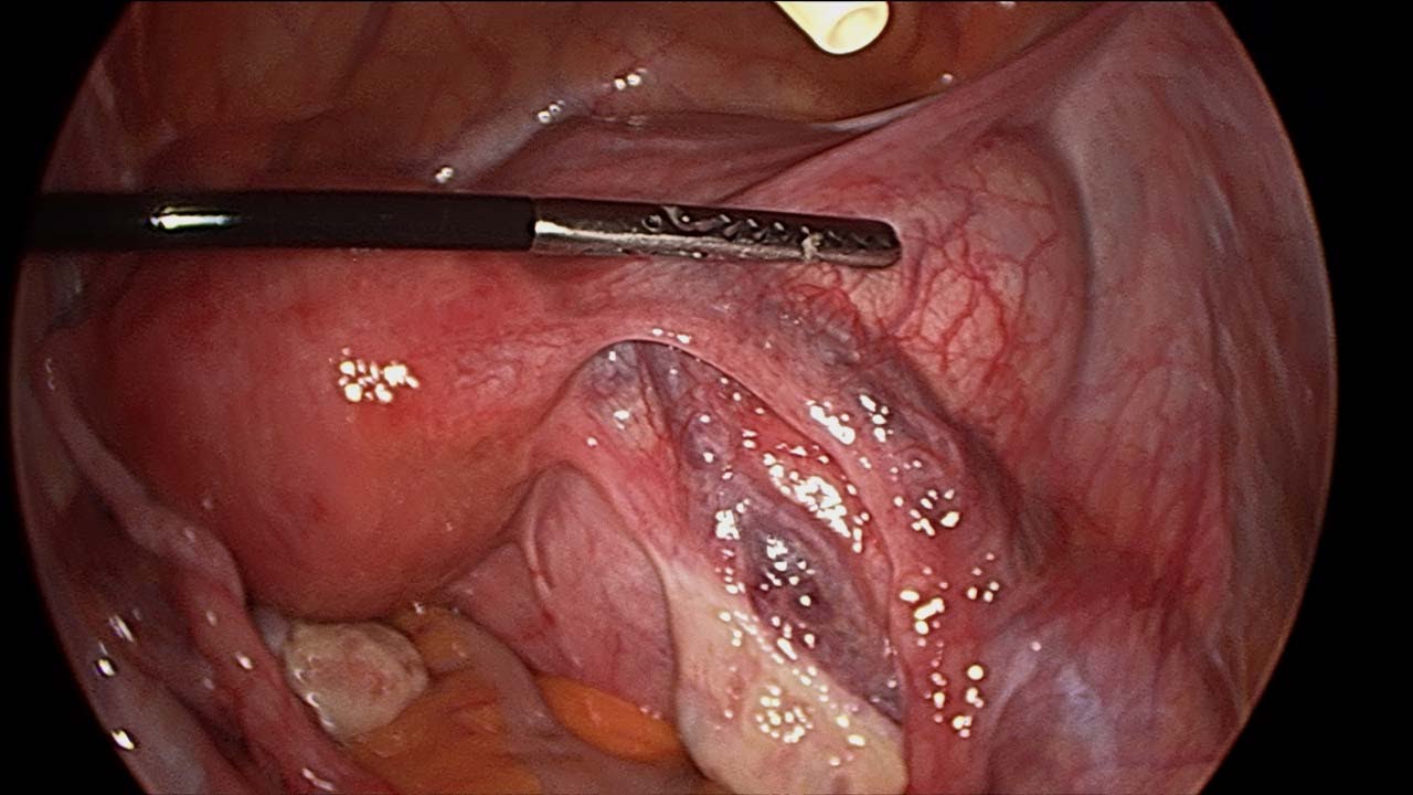 Laparoscopic Oophorectomy for Ovarian Torsion • Video •