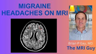 Migraine headaches on MRI