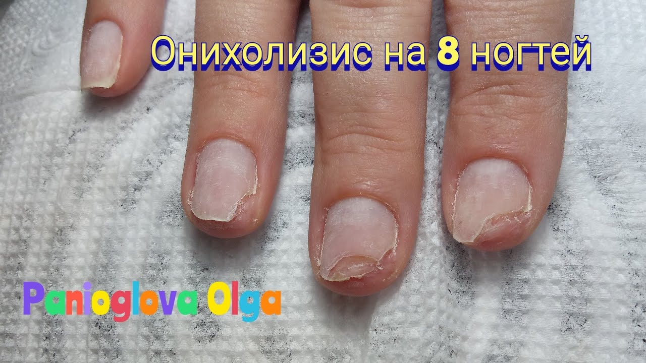 Онихолизис можно покрывать лаком. Онихолизис ногтей зачистка. Травматический онихолизис ногтей.