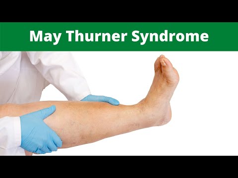 May Thurner Syndrome