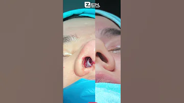 احدى الحالات التي أجراها أطباء مشفى زين لعملية تجميل أنف مع نتائج مذهلة 