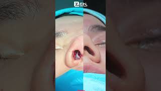 احدى الحالات التي أجراها أطباء مشفى زين لعملية تجميل أنف مع نتائج مذهلة