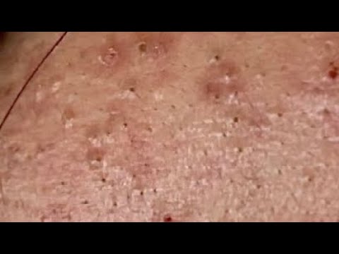 Blackheads