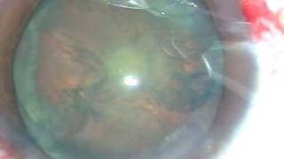 Phaco of Soft Cataract : Lens Tilt Technique screenshot 4