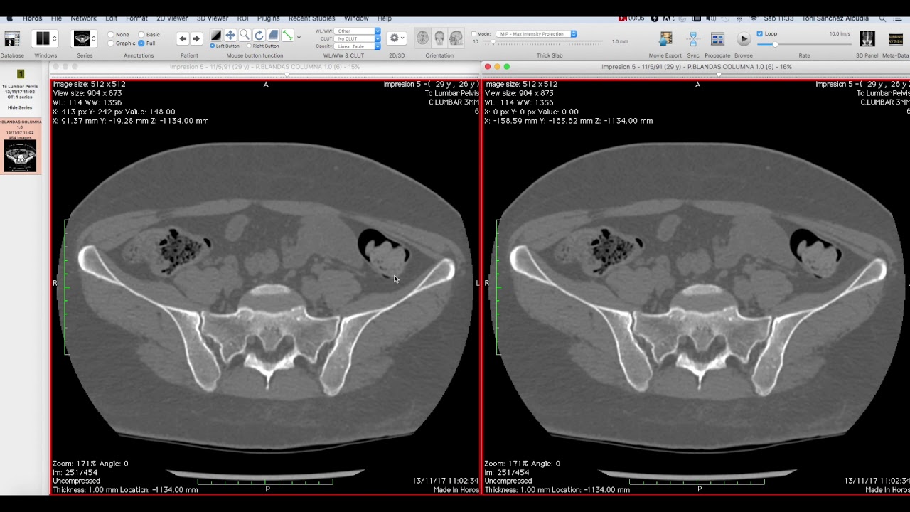 VISOR DICOM HOROS : OSIRIX 10