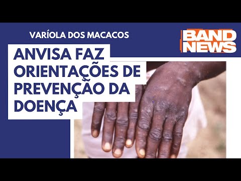 Anvisa faz orientações de prevenção da varíola