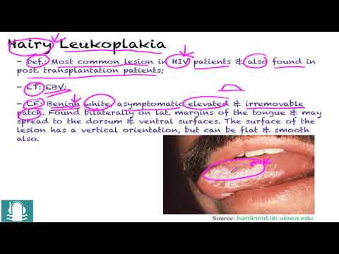 Video: Leukoplakie - Symptomen, Behandeling, Eenvoudige En Harige Leukoplakie