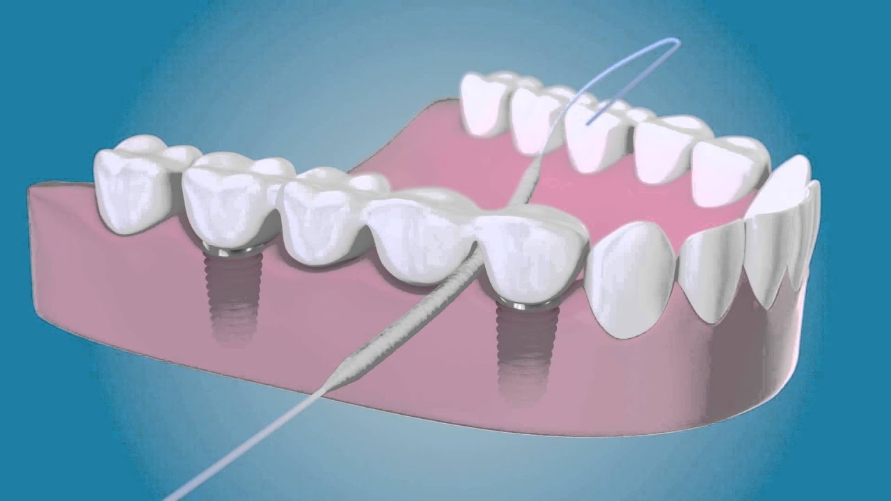 Bridge And Implant Floss by TePe YouTube