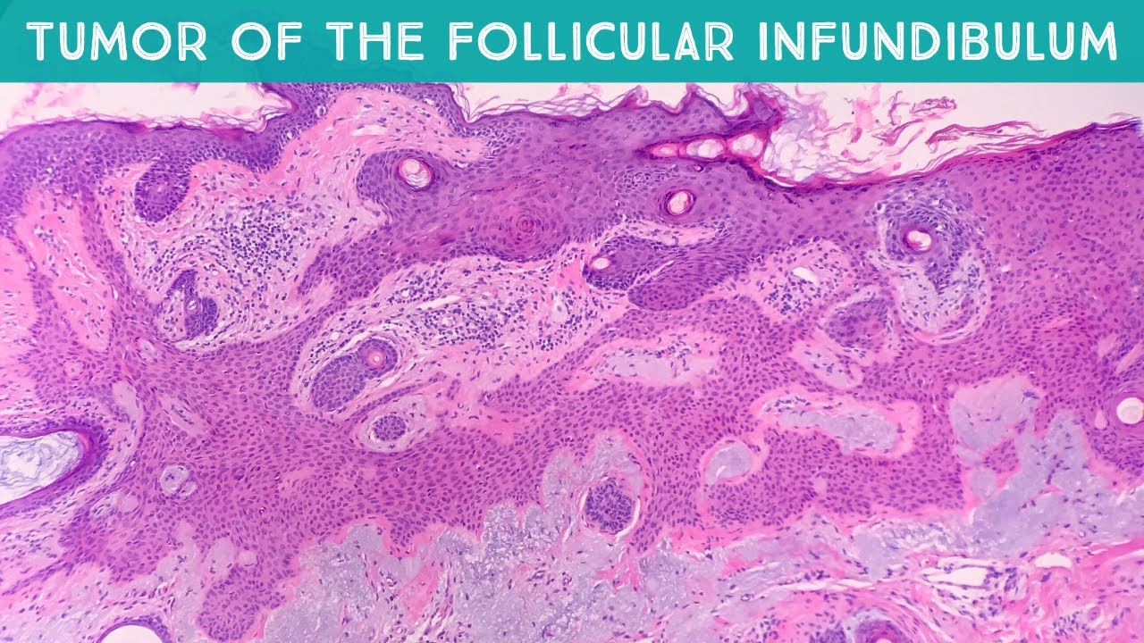 Tumor Of The Follicular Infundibulum Tfi Dermpath In 5 Minutes