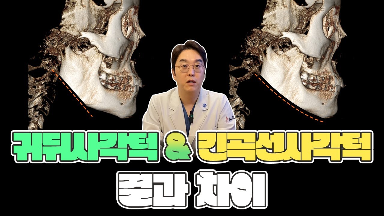 귀뒤사각턱 vs 긴곡선사각턱 수술 결과와 차이점 완벽 정리