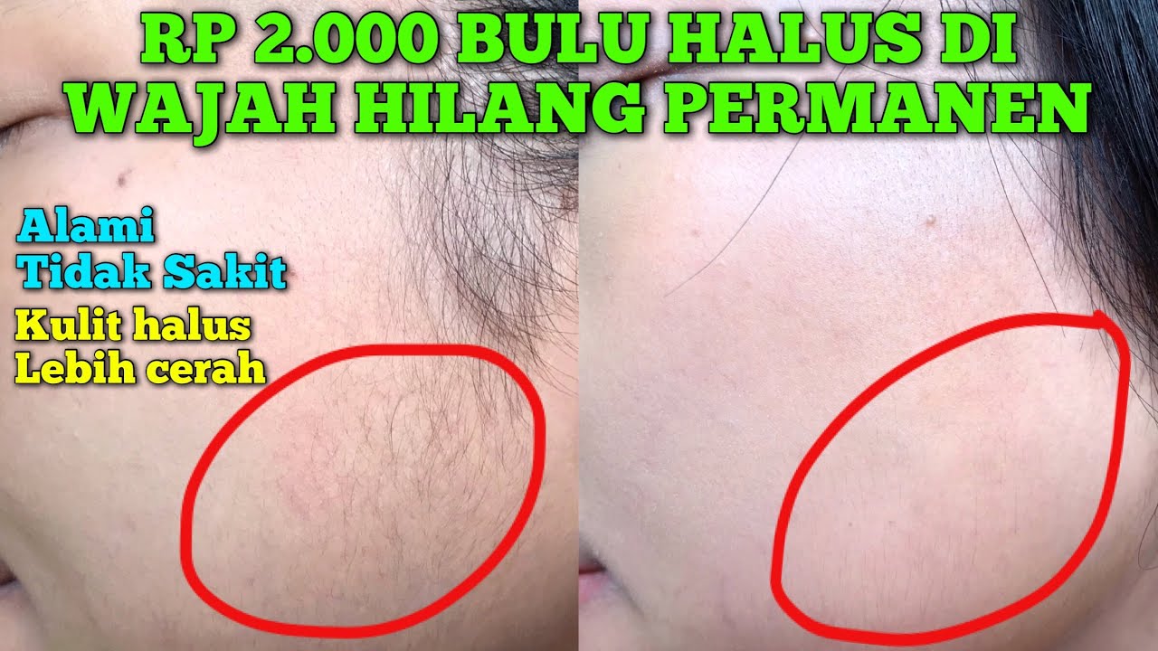 BULU HALUS DI WAJAH HILANG PERMANEN CUMA DENGAN RP 2000!! BAHAN ALAMI ...