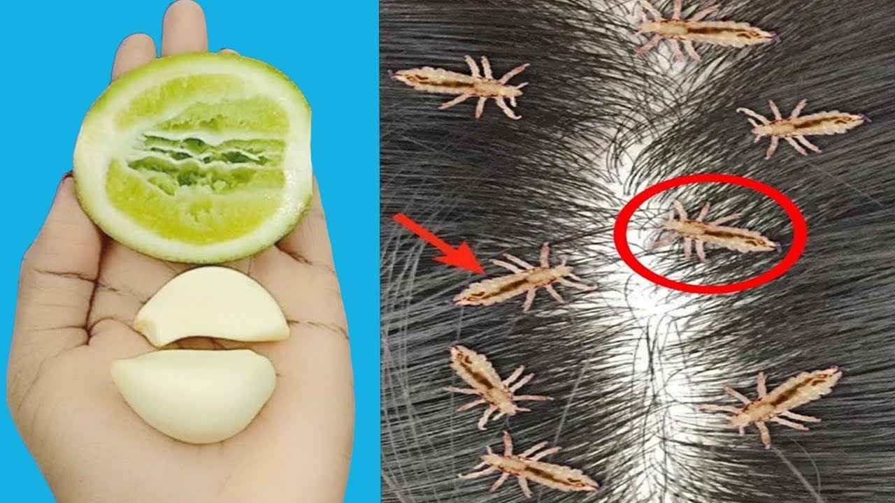 Eliminate Lice Abolish Ways To Eliminate Lice Remove Lice 100