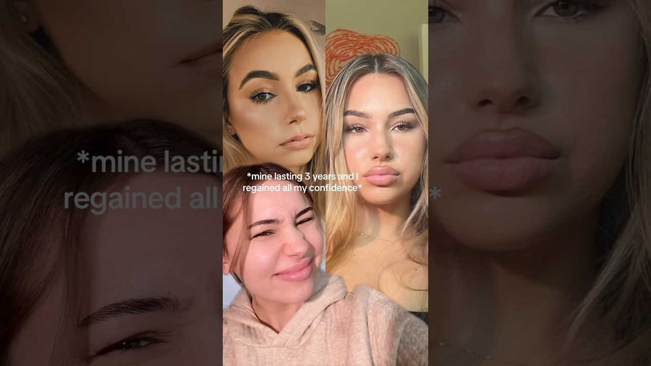 “Lip fillers ugly” 