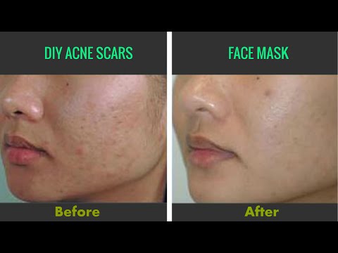 Get Rid of Acne Scars & Dark Spots Fast  At Home/FLAWLESS SKIN/DIY Face Mask