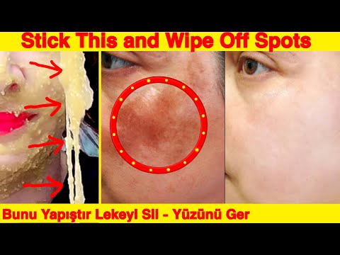 Stick This onto Spots and Wipe Them Off ! Non-Surgical Face Lift - Spot Treatment at Home -Skin Care