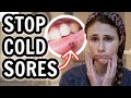 How to treat cold sores FAST| Dr Dray