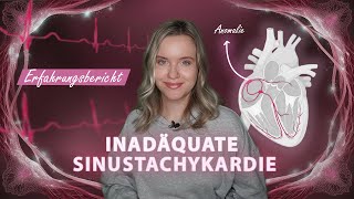 Heart racing for no reason? My experience with inappropriate sinus tachycardia (IST) 🩺