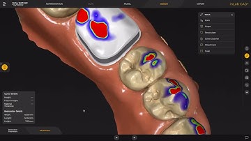telescoop kroon mogelijkheid in de inLab 22 software