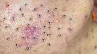 Relax Skincare Everyday with Acne Blackheads Treatment Spa #98173