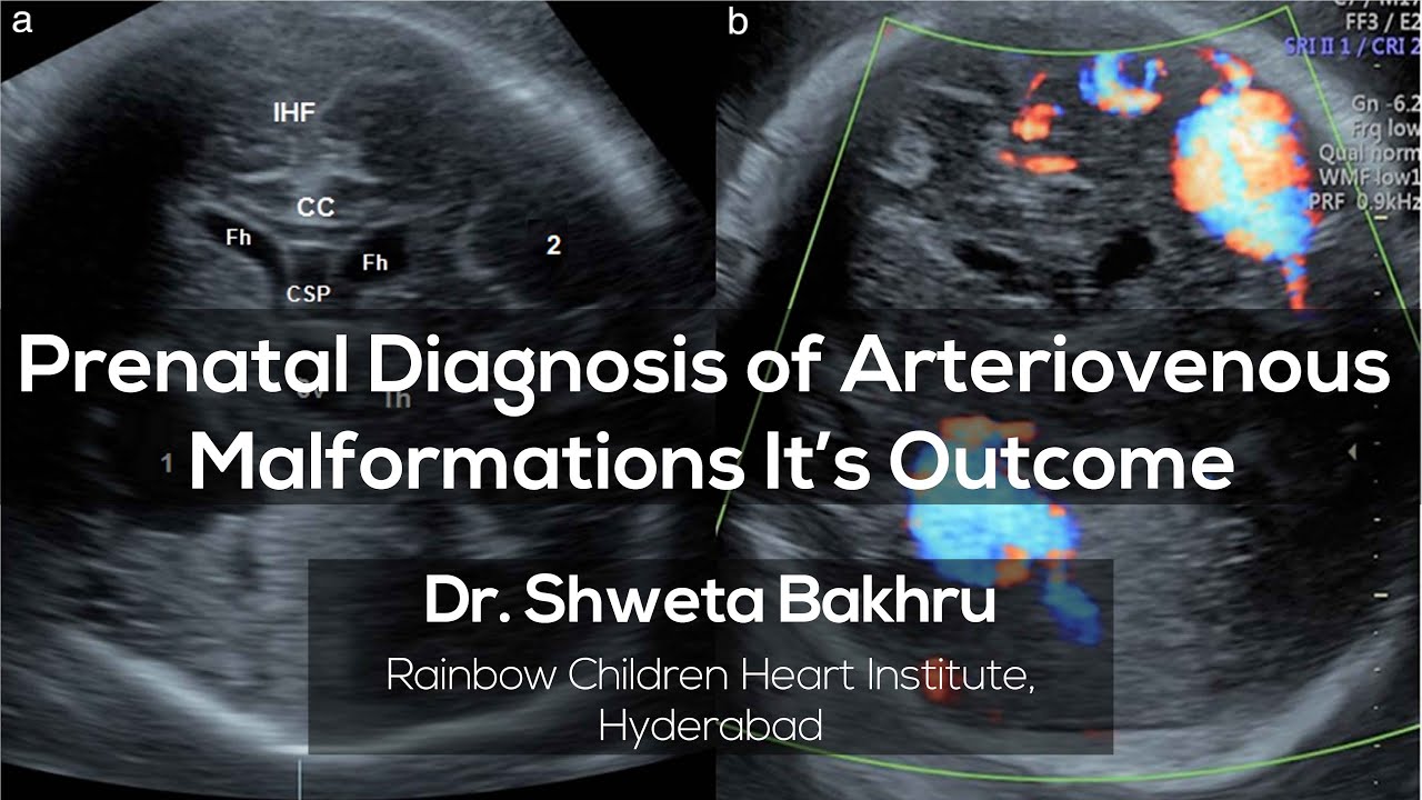 Prenatal Diagnosis of Arteriovenous Malformations It’s Outcome - YouTube