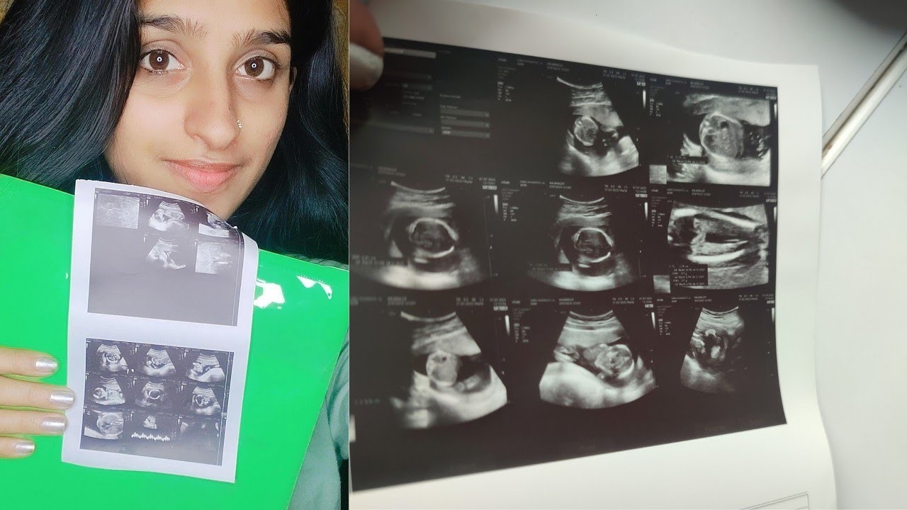 Anomaly scan / mini vlog / ഗ്ലൂക്കോസ് ചതിച്ചതാ 🤦‍♀️ - YouTube