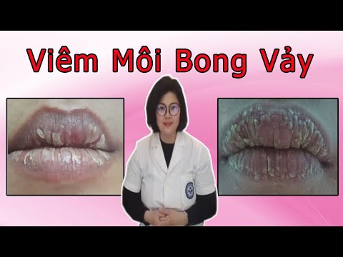 Video: 3 cách để chữa lành môi bị bong tróc