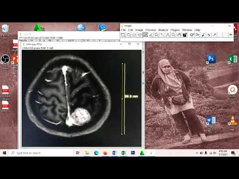 Video: Ahli Radiologi Menyembunyikan Akumulasi Logam Berat Di MRI - Pandangan Alternatif