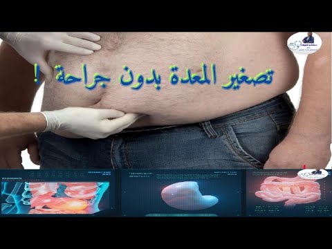 فيديو: حالة المعدة الملتوية - ديلي فيت