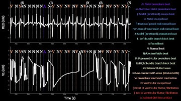 RealTime Electrocardiogram MIT-BIH Arrhythmia Database N°200with tag annotations.