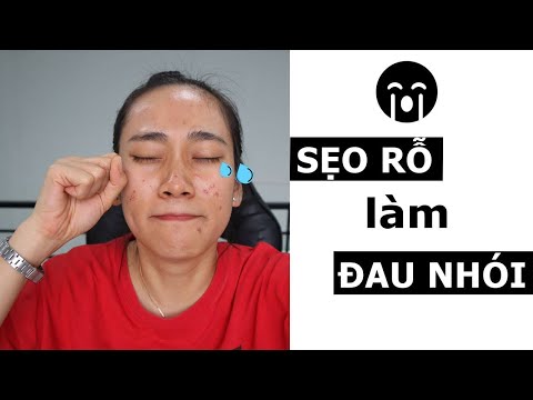 👎 Nặn mụn sai cách đi rồi phải đi trị sẹo rỗ ha 😭| Sống hiệu quả | Ngọc Ngọc