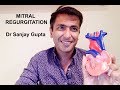 Mitral regurgitation