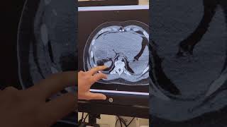 So I had my fourth ablation today heres how it went kfg...
