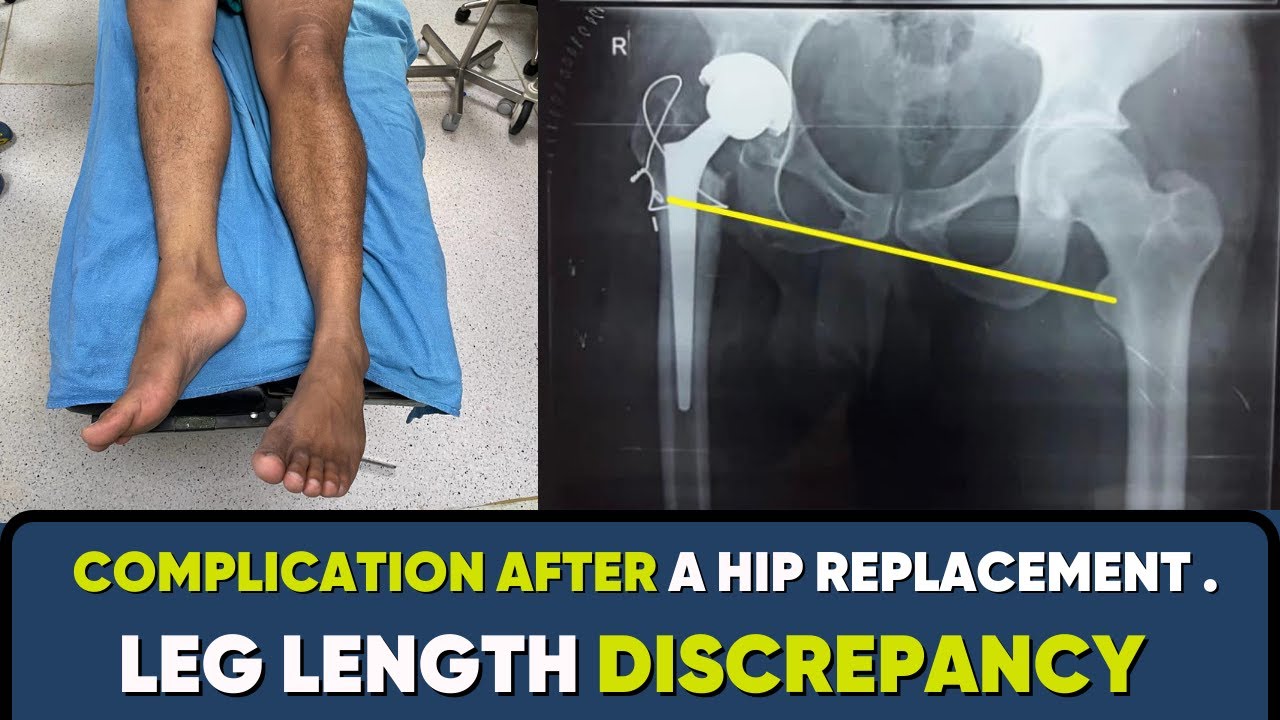 Hip replacement के बाद टांग छोटी बड़ी क्यों होती है? Leg length