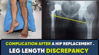 Hip replacement के बाद टांग छोटी बड़ी क्यों होती है? Leg length difference after hip replacement screenshot 1
