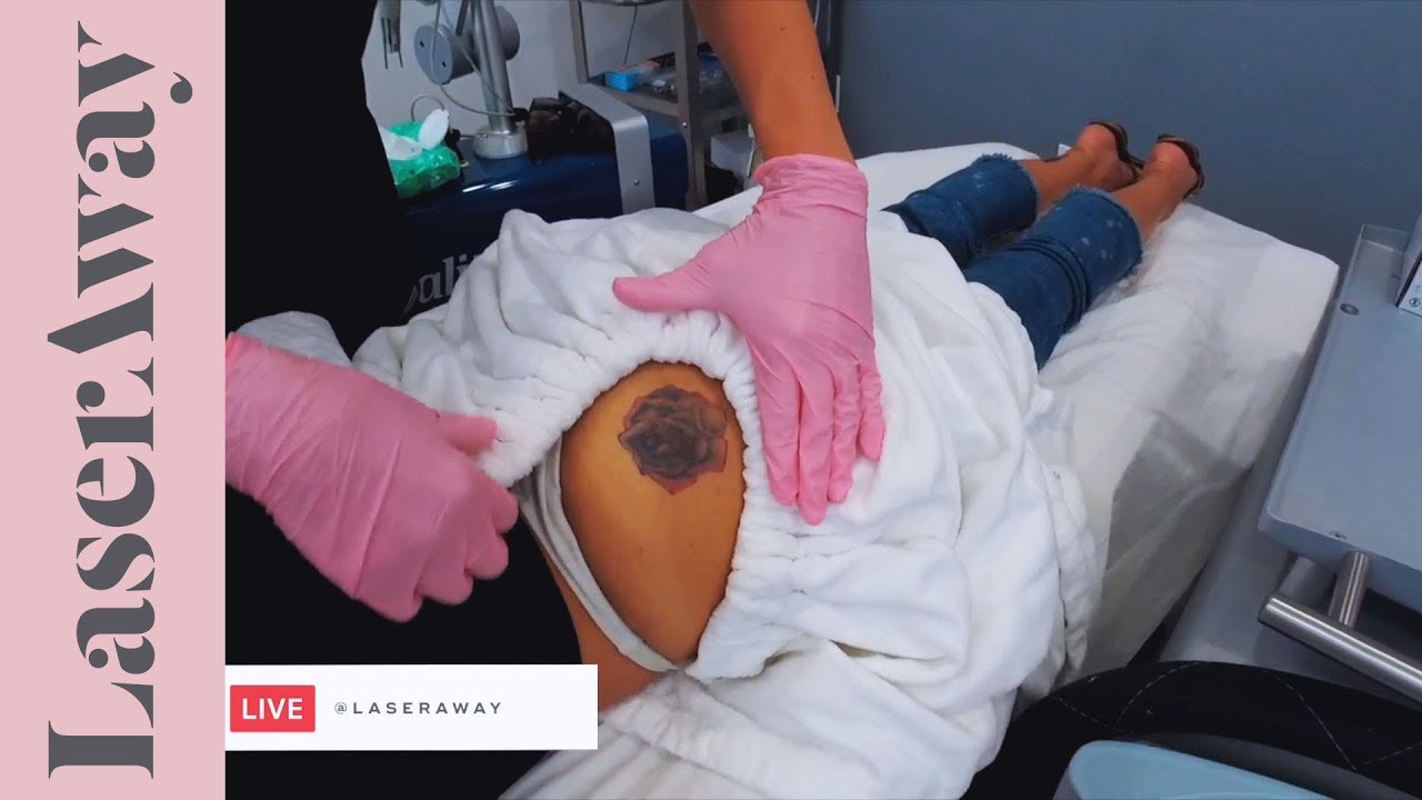 Laser Tattoo Removal LIVE Session at LaserAway  YouTube