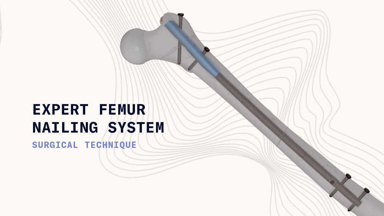 Expert Femoral Nailing System | Advanced Intramedullary Fixation by ...