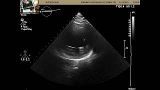 УЗИ сердца через 3  месяца после обширного инфаркта. ФВ 25%