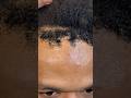 There’s CHUNKS missing from his hairline