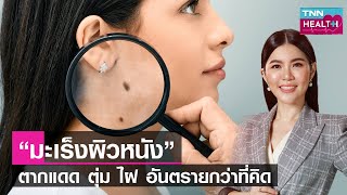 เช็กสัญญาณเตือน “โรคมะเร็งผิวหนัง” รู้เร็ว รักษาได้ มีโอกาสหายขาด : TNN Health