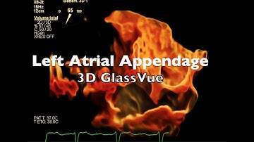 Left Atrial Appendage: 3D GlassVue Assessment