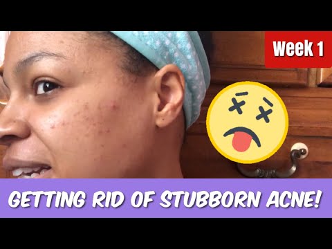 What Happened To My Acne When I Stopped Using Products! // WEEK  #NoBUY