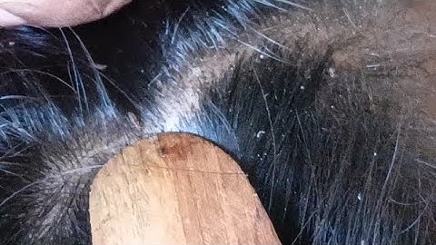 #heavy lice#removel#with real sound#dry hair