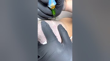 Camouflaging a Hair Transplant Scar / ScalpMicropigmentation