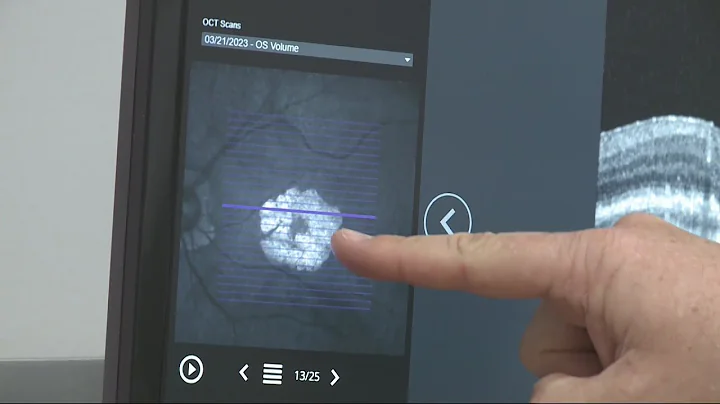 New Treatment for Macular Degeneration Geographic Atrophy Sufferers