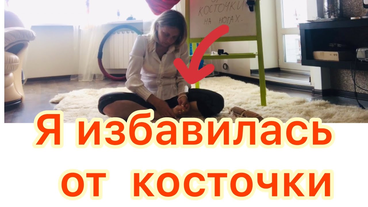 Как избавиться от косточки на ногах. Здоровые ноги. Просто. - YouTube