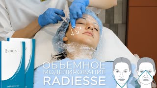 картинка: Векторный лифтинг лица | Используем Radiesse как волюмайзер и армирант