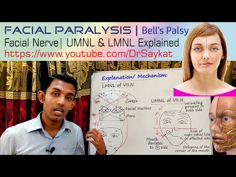 Video: Verschil Tussen Bell's Palsy En Facial Palsy