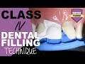 Class IV Composite Filling Tutorial | Front Tooth Filling